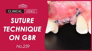 Suture technique on GBR  Dr Kim Jaeyoon [upl. by Larner]