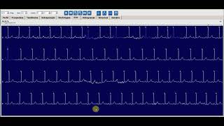 Telecardiologia no Holter 24h  Bigeminismo Atrial Bloqueado  TME Telemedicina [upl. by Aiyt]