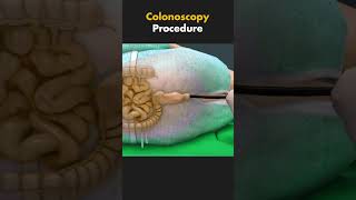 How Colonoscopy is performed 3dmedicalanimation ytshorts medical3danimation [upl. by Ecnahs]