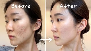 3 Secrets to Clearing Acne Without Medication No Accutane  Tretinoin [upl. by Estis]