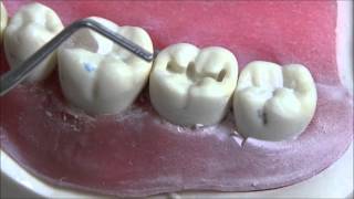 Class I Cavity Preparation on Typodont [upl. by Henley673]