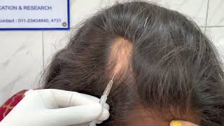 Alopecia areata  Injection technique for Triamcinolone acetonide  10 mgmL Dr Bhawuk Dhir [upl. by Romney]