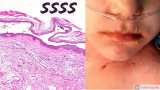 Staphylococcal scalded skin syndrome SSSS 5Minute Pathology Pearls [upl. by Breen]