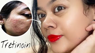 TRETINOIN Before amp After  My skin Transformation with Tretinoin pimple acnetreatment [upl. by Gnurt343]