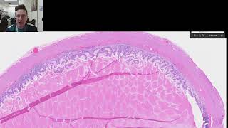 Appendiceal Mucocele vs Lowgrade appendiceal mucinous neoplasm LAMN [upl. by Nylynnej]