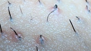 JUICY SATISFYING INGROWN HAIR PULL😍😍😍 [upl. by Akenihs149]