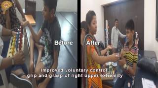 Cerebral Palsy New Treatment Results  Quick Look [upl. by Yttiy960]