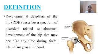 Developmental Dysplasia of Hip Kerala Nurses Hub [upl. by Enyal]