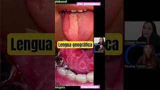 Lengua geográfica 👅 🌎 shorts lengua lenguageografica glositismigratoriabenigna patologiabucal [upl. by Studner876]