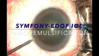 SymfonyEDOF IOL amp Phacoemulsification [upl. by Nomzaj14]