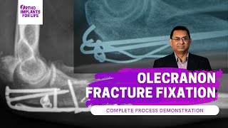 Olecranon Fracture Fixation  Procedure Demonstration [upl. by Alford649]