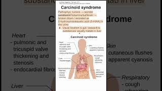 Carcinoid syndrome [upl. by Gasparo579]