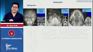 OTORRINOLARINGOLOGÍA Rinología Fractura nasal [upl. by Shipley]