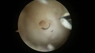 Arthroscopic Microfracture of the Knee with PowerPick [upl. by Calder]