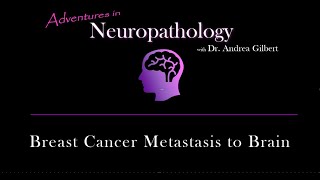 Breast Cancer Metastasis to Brain [upl. by Gowrie]