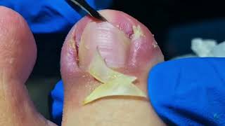 Dig Out Ingrown Toenails FAST with These Simple Steps [upl. by Flam]