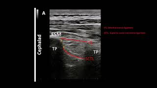 Ultrasound guided Sub transverse process interligamentary STIL block PARAVERTEBRAL BY PROXY [upl. by Nared614]