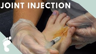 Steroid Joint Injection  Dr Jamie Carter [upl. by Ecirtahs]