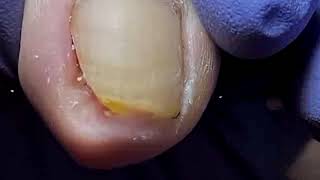 DIY Ingrown Toenail Removal  How to Safely Cut Ingrown Toenails at Home [upl. by Halley]