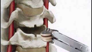 SecureC Cervical artificial disc Replacement Hussien ElMaghraby [upl. by Nawj]