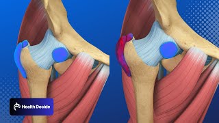 Hip Pain Trochanteric Hip Bursitis  3D Animation [upl. by Trebmer189]