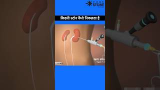 PCNL  percutaneous nephrolithotomy  Kidney stone treatment shortsviral [upl. by Olwena]