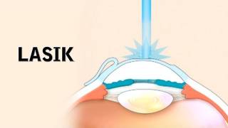 LASIK Surgery and its Risks [upl. by Hodess]