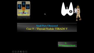 Ultrasound Case 9  Thyroid Nodule TIRADS V Papillary carcinoma [upl. by Bevan]