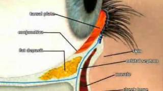 Eye bag removal transconjunctival blepharoplasty [upl. by Novled]