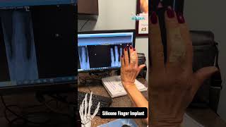 Impressive before and after xrays  🫨 Finger Arthritis PIP Joint [upl. by Judye]