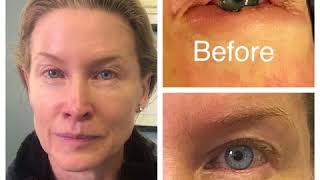 Left Lower Eyelid Skin Cancer Reconstruction Surgery testiomonial [upl. by Philpot]