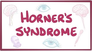 Horners syndrome  causes symptoms diagnosis treatment pathology [upl. by Ilah144]