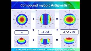 A Quick Guide to Reading Corneal Tomography Part 3 [upl. by Seuguh]