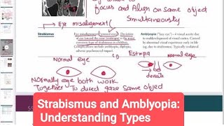 Strabismus and Amblyopia Understanding Types opthalmology 28  First Aid USMLE Step 1 in Urdu [upl. by Uella]