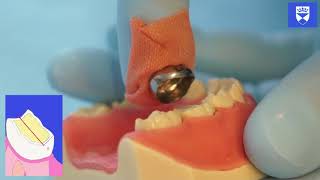 Stainless Steel Crown Technique for a Primary Molar Tooth [upl. by Tammie]