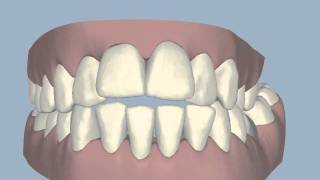 Invisalign ClincheckIncreased overlap of teethwmv [upl. by Sayette444]