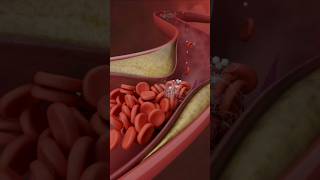 Lower Limb Angioplasty and Stenting3D Medical Animation LowerLimbStentingShorts LowerLimbviral [upl. by Miche900]