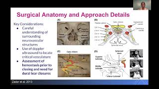 Pituitary Adenomas Diagnosis and Management by Sheena Kalagara [upl. by Ailic708]