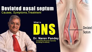 Deviated nasal septumDNS in Bangla নাকের হাড় ব্যাঁকায় করনীয় [upl. by Farron527]