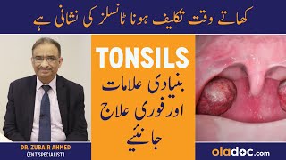 Tonsils Ka Ilaj In Urdu  Tonsils Symptoms Treatment  Galay Ke Gadood Barhna  Tonsils Ki Alamat [upl. by Acnayb383]