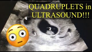 QUADRUPLETS ULTRASOUND  LOU YZA [upl. by Kathe23]