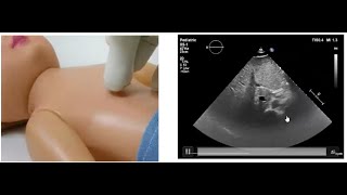 Basics of Pediatric Echocardiography Determining the Situs by Dr Gaurav Agrawal [upl. by Eelak]