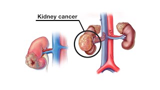 Mayo Clinic Minute  How is kidney cancer treated [upl. by Amyaj]