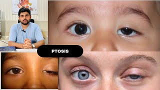 Ptosis and its classification drhashimjabbar education optometry eye ptosis [upl. by Aggappe166]