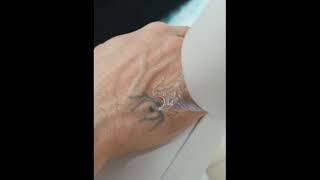 Tattoo Removal With The Q Switched NdYAG  Lumenis [upl. by Gnivri]