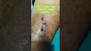 Non healing Wounds treatment with leech therapy unanidoctor unani skincare [upl. by Hugo]