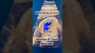 Tetrology of Fallot  Fetal echo  Dr Surbhi Gupta Aggarwal [upl. by Oni]