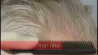 Hair Transplant Results  Norwood 5  3000 Grafts  Forhair Videos [upl. by Bradford712]