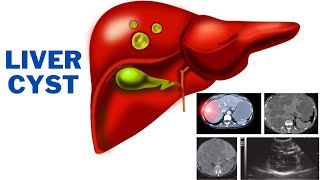 Liver cyst  What do you need to know about liver cysts  247nht [upl. by Gene]