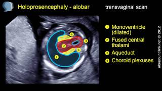 Holoprosencephaly alobar [upl. by Gala]